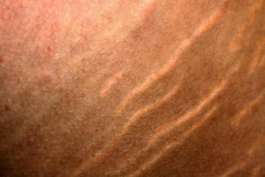 Embracing Stretch Marks – Body Journey and Natural Remedies - Dang! Lifestyle Nigeria